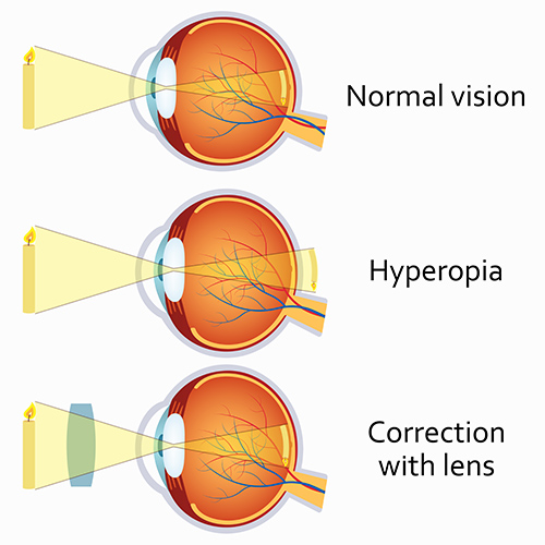 hyperopia