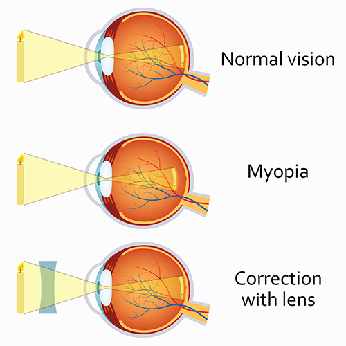 myopia